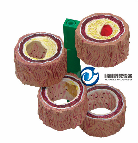 动脉硬化带血栓模型（柱型）