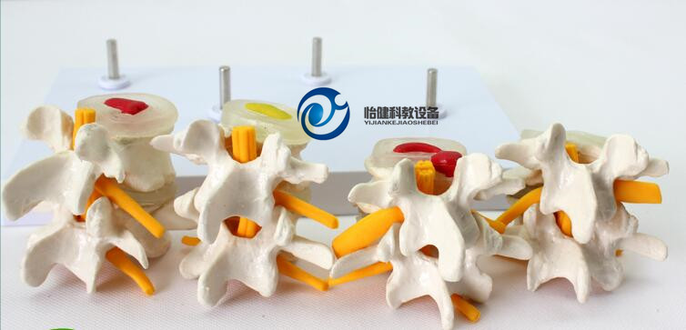腰椎病变演示模型