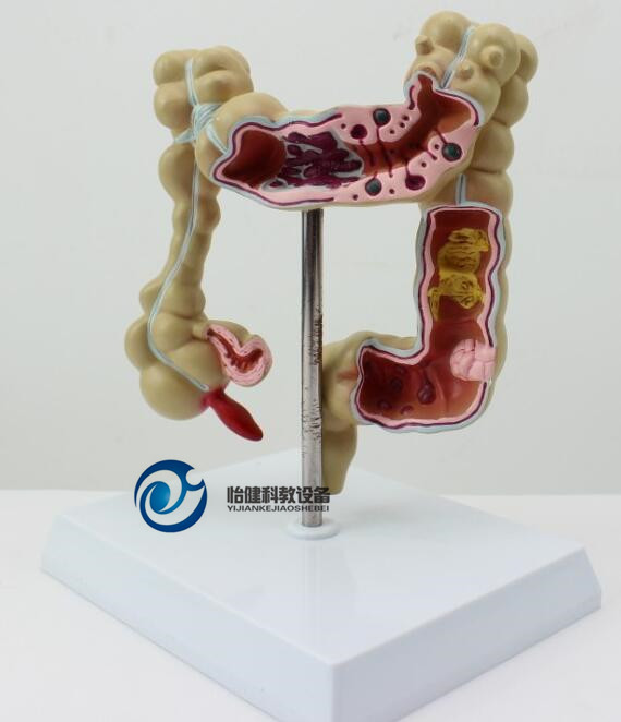 大肠病变模型